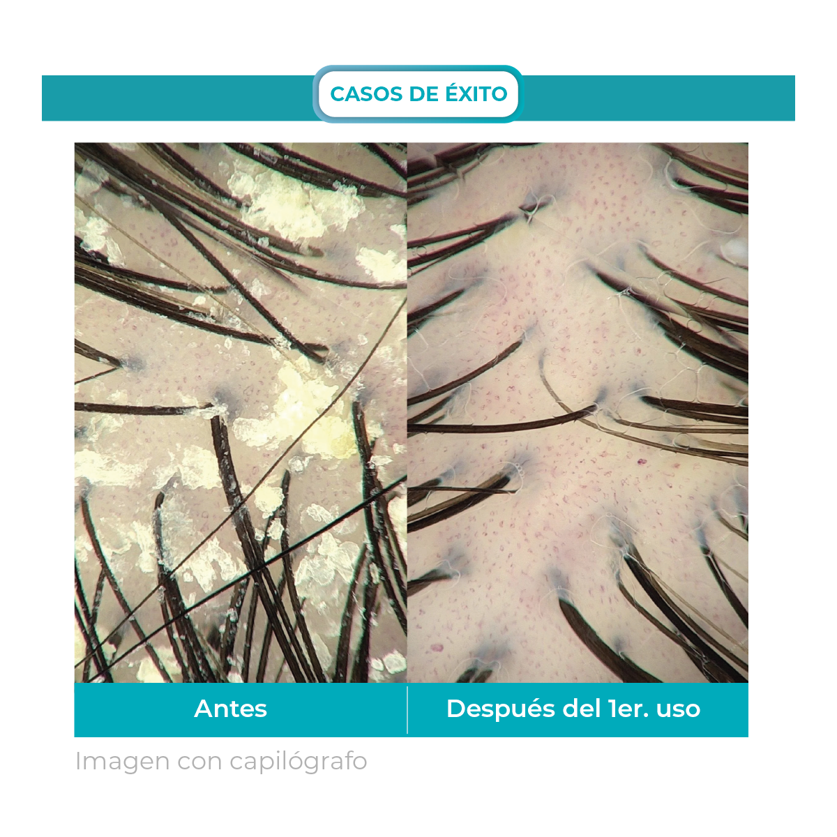 Dandrene® | Shampoo Exfoliante Anti-Caspa